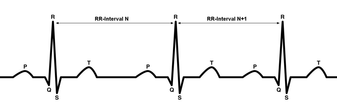 图3.1 心电图波形和RR间隔